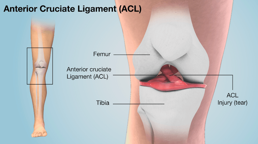 Understanding an ACL Tear